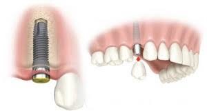 Dental implant for replacing a missing tooth