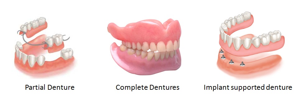 Partial vs full denture - Fixed or removable dentures