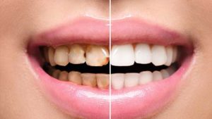 Full mouth dental implants cost reconstruction