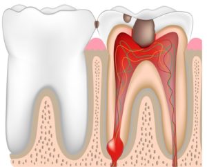 Chronic Dental Infections