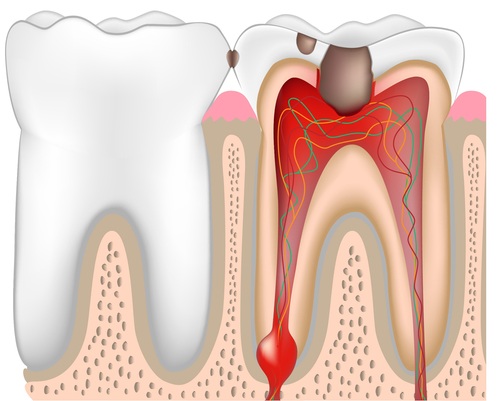 Chronic Dental Infections