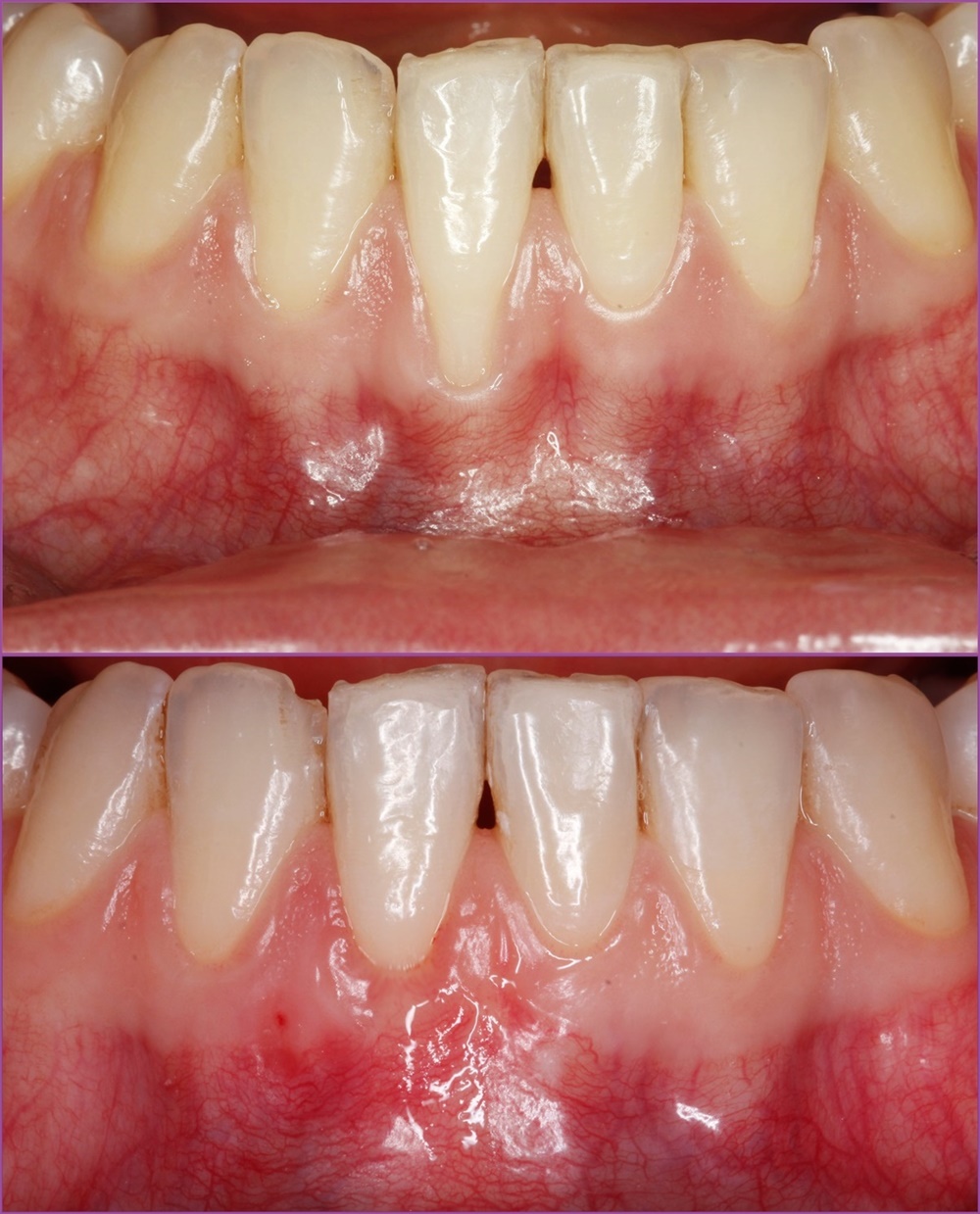 Gum Recession Treatment with Connective Tissue Transplant